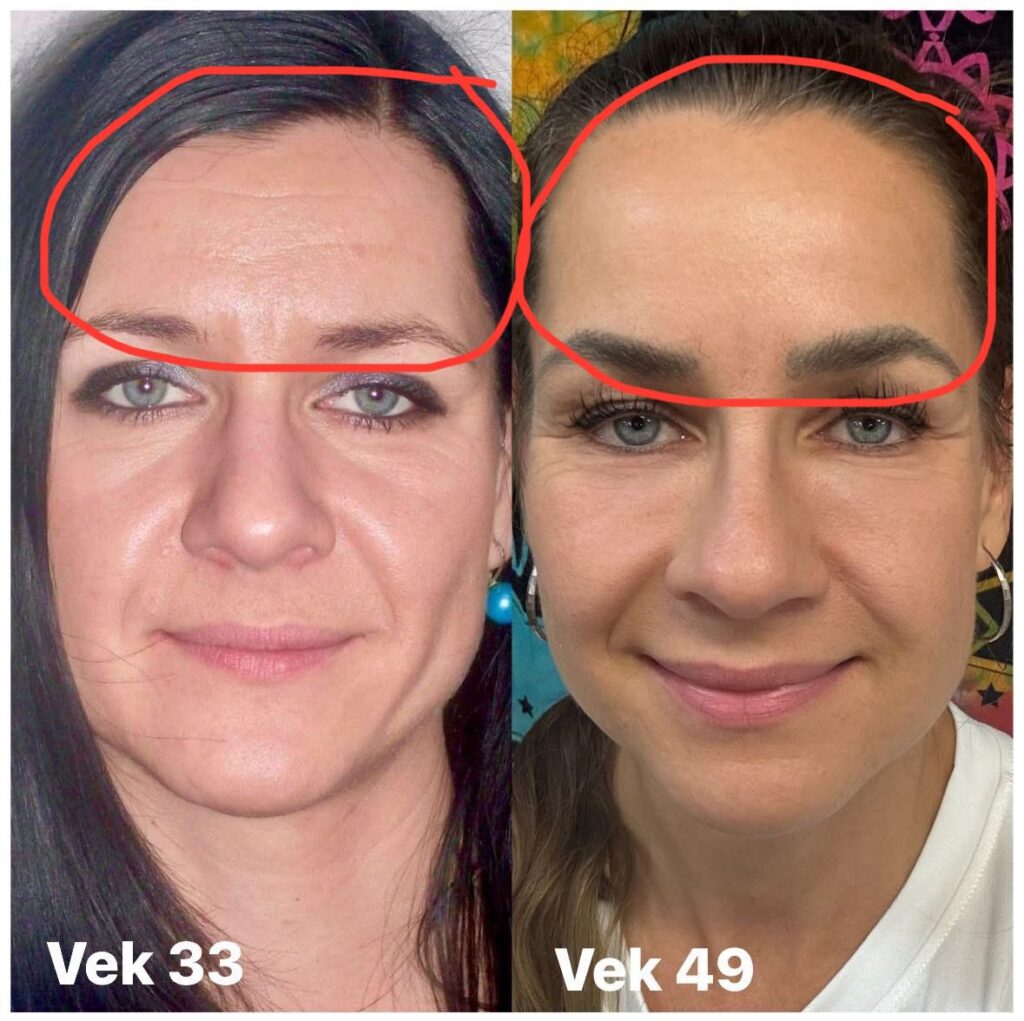 Tvárová gymnastika pre prirodzené vyhladenie vrások na čele